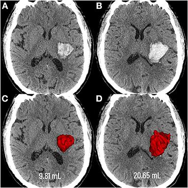 Association Between Anatomical Location and Hematoma Expansion in Deep Intracerebral Hemorrhage